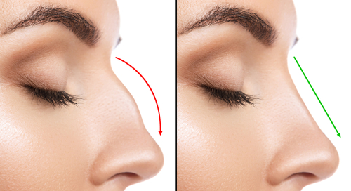 Rhinoplasty Swelling Stages What To Expect In The Days After Surgery